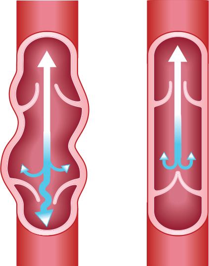 Venous Insufficiency